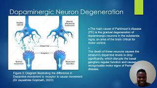 Parkinsons disease [upl. by Aillicec]