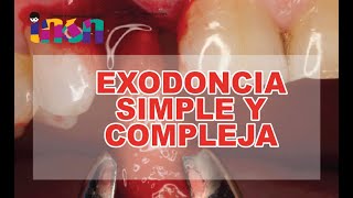 Exodoncia Simple y Compleja  Telecapacitación INSN [upl. by Cherry]