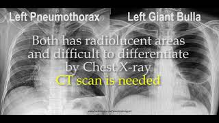 Pneumothorax vs Bulla in Chest X ray [upl. by Gerhardt]