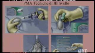 PMA  Procreazione medicalmente assistita [upl. by Ahsita]