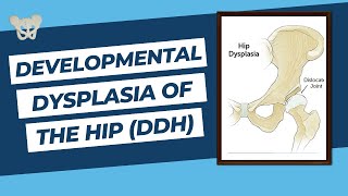 Developmental Dysplasia of the Hip DDH  FRCS Exam Review Orthopaedic Academy [upl. by Howes492]