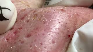 Acne Treatment Huong Da Nang552  2023 [upl. by Airetnahs]