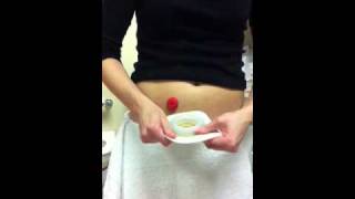 Ostomy pouch change using ConvaTec moldable [upl. by Briscoe92]