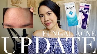 6 MONTH UPDATE ON MY FUNGAL ACNE  jskavee [upl. by Grindle]