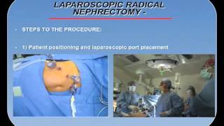 LAPAROSCOPIC RADICAL NEPHRECTOMY PROCEDURE OVERVIEW [upl. by Aidin718]