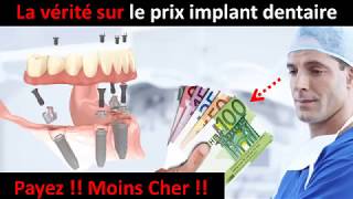 Prix implant dentaire  partie 1 [upl. by Derrej]