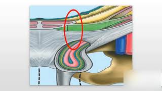 Inguinal Hernias Explained [upl. by Ines]