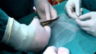 How to Selftailor a 1515 cm polypropylene monofilament mesh for cystocele transvaginal repair [upl. by Dnalkrik474]