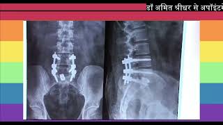 Listhesis at L5S1 and nerve compression  Spine Surgery Case Patients Testimonial DrAmit Shridhar [upl. by Yesor576]