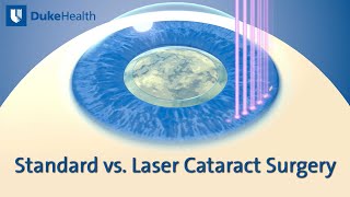 Standard vs Laser Cataract Surgery  Duke Health [upl. by Eulalee]