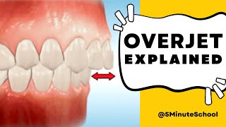 OVERJET  WHAT IS AN OVERJET AND HOW TO FIX IT [upl. by Kendall]