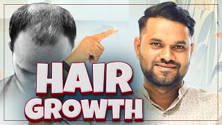 5000 Grafts Hair Transplant Surgery in New Roots Nagpur  Incredible Hair Growth 🔥 [upl. by Higginson]