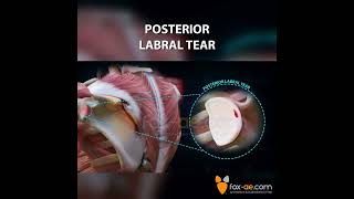 Posterior Labral Tear [upl. by Olaf]