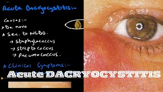 Acute Dacryocystitis  lacrimal system [upl. by Elrebma]