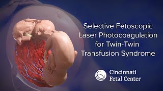 TwinTwin Transfusion Medical Animation TTTS  Cincinnati Fetal Center [upl. by Marcille]