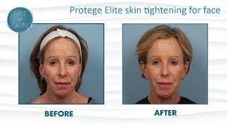 Protege Elite Radiofrequency for Skin Tightening [upl. by Faxen167]