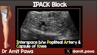 IPACK Interspace between Popliteal Artery and Capsule of the Knee [upl. by Ihc533]