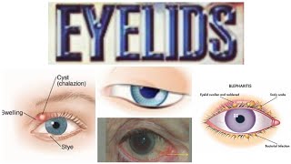 Eyelids 3 Major Topic Hordeolum [upl. by Haldan]