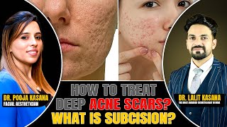 How To Treat DEEP ACNE SCARS What is SUBCISION  DrLalit Kasana  DrPooja Kasana [upl. by Anavas]