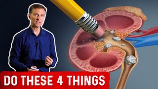 Preventing High Oxalate Kidney Stones [upl. by Goodman]