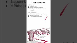 Ovarian torsion [upl. by Gare668]