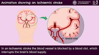 Animation showing an ischaemic stroke [upl. by Penthea]