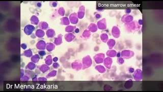 Acute Myeloid Leukemia AML M3 [upl. by Clover]