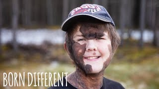 Boy With Giant Mole Beats The Bullies  BORN DIFFERENT [upl. by Hendrik]