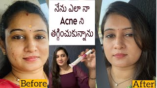 How I Cleared My Acne and Marks  My Acne Journey Clear Skin With Pictures  Treatment amp Products [upl. by Guthrey]