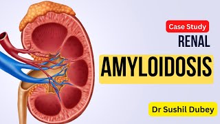 RENAL AMYLOIDOSIS URGENT amp EMERGENCY CASE STUDY  AEON HOMOEOPATHY  DR SUSHIL DUBEY  ARSENICUM A [upl. by Shamrao923]