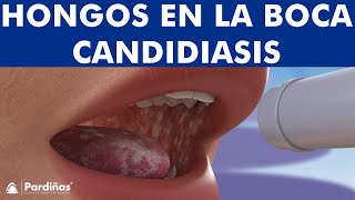 CANDIDIASIS oral y BOQUERAS  Cómo CURAR los hongos de la boca © [upl. by Viens]