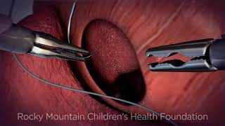 Minimally Invasive Surgery for Congenital Diaphragmatic Hernia [upl. by Aetnuahs581]