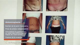 Abdominoplastie à Perpignan Chirurgie esthétique et plastique [upl. by Merrow472]