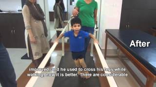 Spastic Quadriplegic Cerebral Palsy Treatment Result [upl. by Einttirb269]