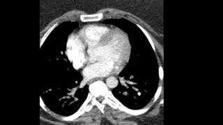 Pulmonary Embolism CT Discussed by Radiologist [upl. by Arretahs383]