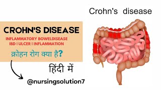 Crohns disease in hindi  Inflammatory bowel disease in hindi  Type  Cause  Symptoms  Treatment [upl. by Nodnas840]