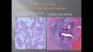 Histology of Choriocarcinoma [upl. by Solokin56]