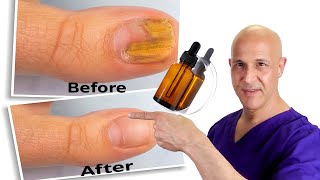 1 Oil Cures Toe Nail Fungus  Dr Mandell [upl. by Osana]