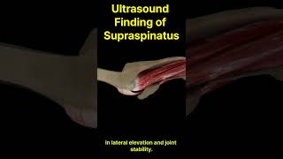 Diagnosing the Supraspinatus Ultrasound as the Ultimate Tool 초음파 검사 극상근 진단의 열쇠 [upl. by Joselyn]