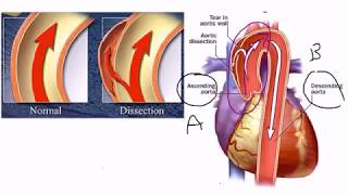 Aortic Dissection [upl. by Anytsirk]