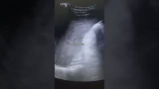 Hepatic calcification on USGcomedy usg trending baby usgsfactsviralvideoshorts youtubeshort [upl. by Aekim]