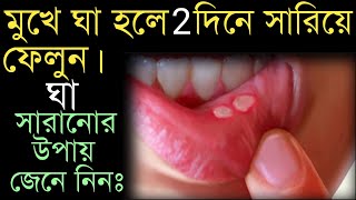 মুখের ঘা দূর করার উপায়mukhe gha hole ki korboমুখে ঘা হলে কি করবেনমুখের ঘা সারানোর উপায়। [upl. by Asi]