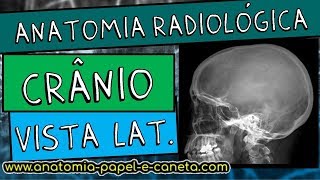 Anatomia radiológica RX do crânio  VISTA LATERAL  PERFIL [upl. by Otiragram588]