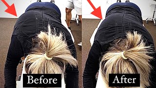 Straightening SEVERE SCOLIOSIS with Chiropractic Adjustments [upl. by Jameson]