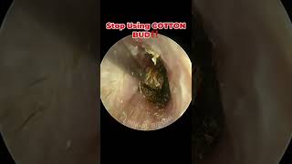 Deep Impacted Cerumen With Severely Swollen Ear Canal [upl. by Ongineb]