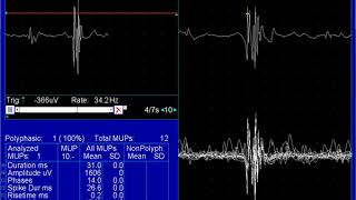 Polphasic MUAP brachial neuritis [upl. by Htennaj26]