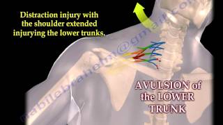 Brachial Plexus Mechanism Of Injury  Everything You Need To Know  Dr Nabil Ebraheim [upl. by Eibo]