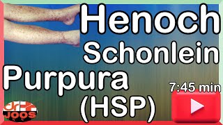 Henoch Schonlein Purpura HSP ׀ Basic necessary facts amp management ׀ Made easy  dr joos [upl. by Eelinej]