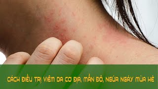 Trực tiếp CÁCH ĐIỀU TRỊ VIÊM DA CƠ ĐỊA MẨN ĐỎ NGỨA NGÁY MÙA HÈ  Sức khỏe vàng VTC16 [upl. by Acsehcnarf101]