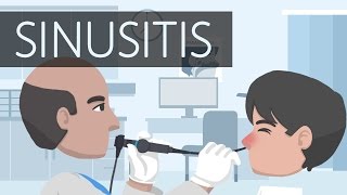 What is Sinusitis [upl. by Ydnagrub]